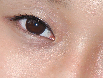 鼻子两侧长小米粒疙瘩，你所不知道的小疙瘩  疙瘩 米粒 鼻子 美白祛黄 第3张