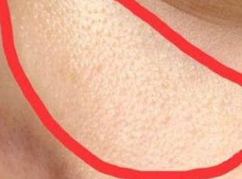 鼻子两侧长小米粒疙瘩，你所不知道的小疙瘩  疙瘩 米粒 鼻子 美白祛黄 第4张