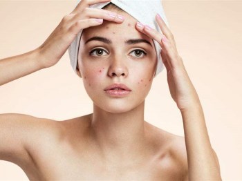 三十多岁脸上长痘什么原因怎么办  怎么办 原因 美白祛黄 第2张