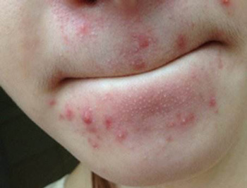 嘴巴周围长痘的原因，注意5种帮你祛痘