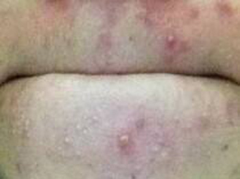 嘴巴周围长痘的原因，注意5种帮你祛痘  长痘的原因 美白祛黄 第3张