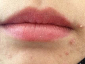 嘴巴周围长痘的原因，注意5种帮你祛痘  长痘的原因 美白祛黄 第4张