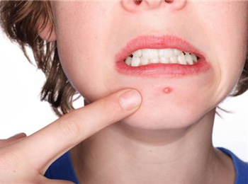 嘴巴周围长痘的原因，注意5种帮你祛痘  长痘的原因 美白祛黄 第5张