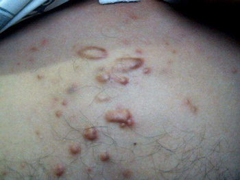 胸前长痘痘是什么原因，分析5种常见情况