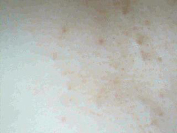 胸前长痘痘是什么原因，分析5种常见情况  长痘的原因 美白祛黄 第3张