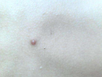 胸前长痘痘是什么原因，分析5种常见情况  长痘的原因 美白祛黄 第5张