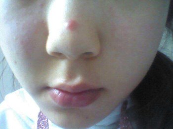 鼻子周围长痘痘是什么原因，不要随便处理鼻子上的痘  痘痘 鼻子 原因 美白祛黄 第2张