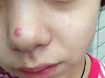 鼻子周围长痘痘是什么原因，不要随便处理鼻子上的痘  痘痘 鼻子 原因 美白祛黄 第3张
