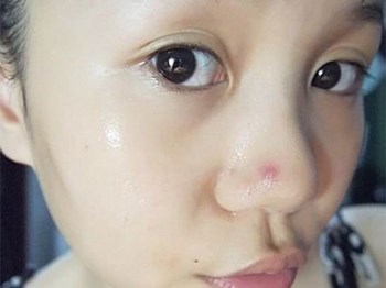 鼻子周围长痘痘是什么原因，不要随便处理鼻子上的痘  痘痘 鼻子 原因 美白祛黄 第4张