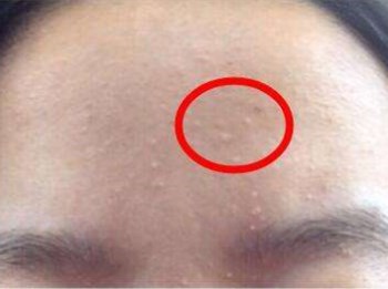 额头上长闭口粉刺什么原因，五大原因助你清理闭口