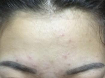 额头上长闭口粉刺什么原因，五大原因助你清理闭口  粉刺 额头 原因 美白祛黄 第3张