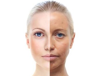 额头上长闭口粉刺什么原因，五大原因助你清理闭口  粉刺 额头 原因 美白祛黄 第4张