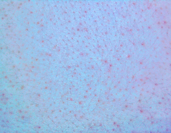 后背长闭合性粉刺，后背粉刺详情解析