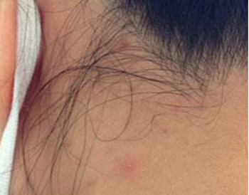 头发跟脖子后边长痘痘，隐藏的痘也要注意