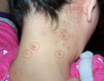 头发跟脖子后边长痘痘，隐藏的痘也要注意  头发 痘痘 脖子 美白祛黄 第2张