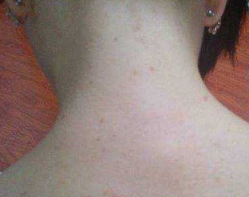 头发跟脖子后边长痘痘，隐藏的痘也要注意  头发 痘痘 脖子 美白祛黄 第3张