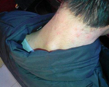 头发跟脖子后边长痘痘，隐藏的痘也要注意  头发 痘痘 脖子 美白祛黄 第4张