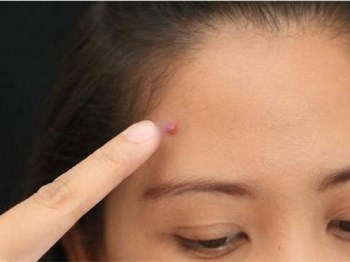 额头长痘痘什么原因，六种原因你了解吗  痘痘 额头 原因 美白祛黄 第2张