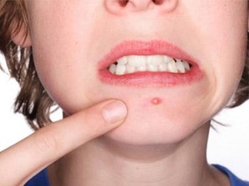 为什么下巴总是长痘痘，具体原因具体分析