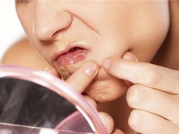 为什么下巴总是长痘痘，具体原因具体分析  痘痘 下巴 美白祛黄 第2张