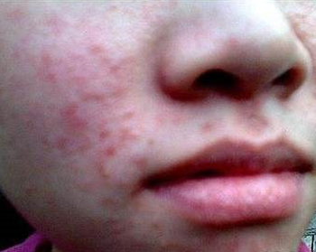 腮两侧长痘频繁的原因，两腮长痘原因大解析