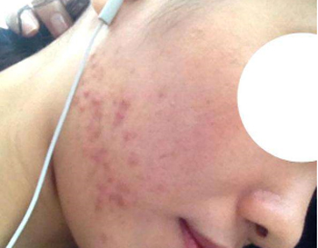 腮两侧长痘频繁的原因，两腮长痘原因大解析  原因 腮两侧 美白祛黄 第2张