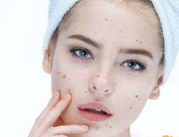 腮两侧长痘频繁的原因，两腮长痘原因大解析  原因 腮两侧 美白祛黄 第3张