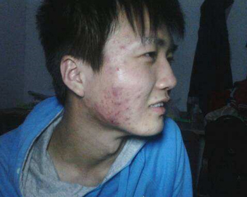 腮两侧长痘频繁的原因，两腮长痘原因大解析  原因 腮两侧 美白祛黄 第5张