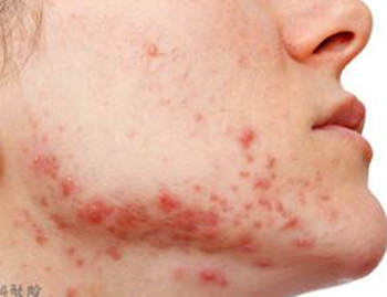 淋巴排毒不畅长痘痘具体情况分析