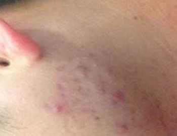 淋巴排毒不畅长痘痘具体情况分析  淋巴 排毒 美白祛黄 第2张