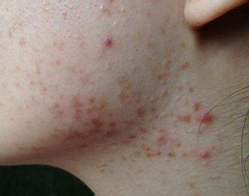 淋巴排毒不畅长痘痘具体情况分析  淋巴 排毒 美白祛黄 第3张