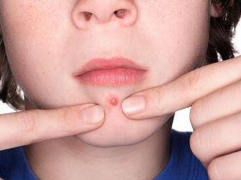 红肿硬大痘痘擦什么药，有效解决炎症痘痘