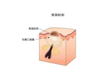 闭口、开口粉刺有什么区别，根据区别找对策  粉刺 美白祛黄 第2张