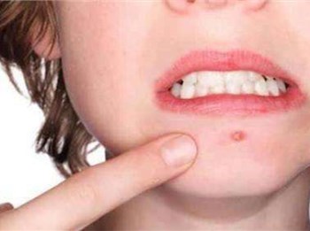 维生素b6去闭口靠谱吗，偏方真假揭秘  维生素 美白祛黄 第3张