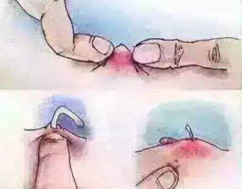 痘痘没挤干净留下硬块，手残挤痘的下场  硬块 美白祛黄 第2张