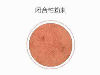 闭合性粉刺形成原因，分析4种  闭合性粉刺 原因 美白祛黄 第1张