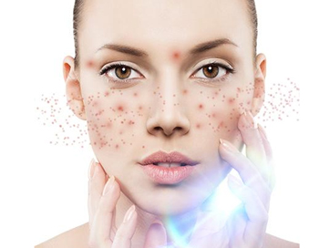 脸上长脓痘能挤吗，看如何正确处理脓痘  脓痘 美白祛黄 第3张