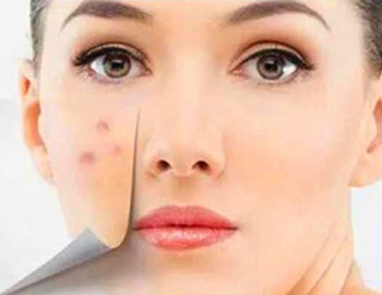 脸上长脓痘能挤吗，看如何正确处理脓痘  脓痘 美白祛黄 第4张