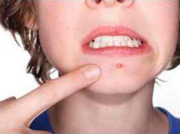 下巴长痘痘是什么原因怎么调理