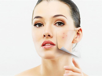 内分泌失调老长痘痘是什么原因怎么办  老长 痘痘 内分泌 美白祛黄 第2张