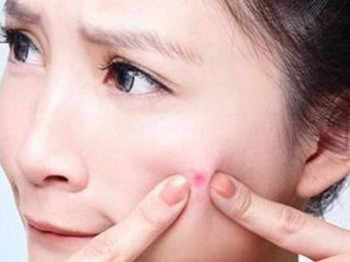 产后脸上长痘痘怎么办，恢复光滑好皮肤