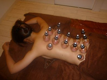 拔火罐能去痘痘吗，看过就知道