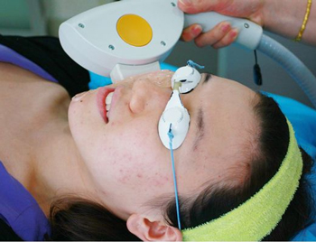 光子嫩肤祛痘会复发吗，所不了解的祛痘方式  祛痘 光子嫩肤 美白祛黄 第4张