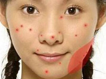 按摩什么部位可以祛痘，小按摩大作用