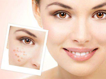 氯霉素治疗痤疮有效吗效果如何  氯霉素 痤疮 效果 美白祛黄 第4张