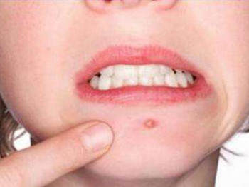 内分泌失调怎么调理脸上老起痘反反复复怎么办  祛痘 美白祛黄 第2张