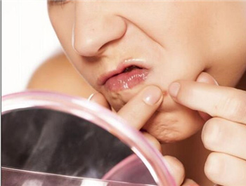 下巴长暗疮又硬又痛什么原因