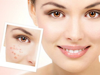 过敏性痘痘怎么调理，八个小妙招来解决