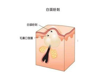 白头粉刺形成的原因及去除小妙招，全面对抗粉刺  粉刺 美白祛黄 第2张
