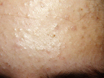 脸上有痤疮能敷面膜吗，推荐两款